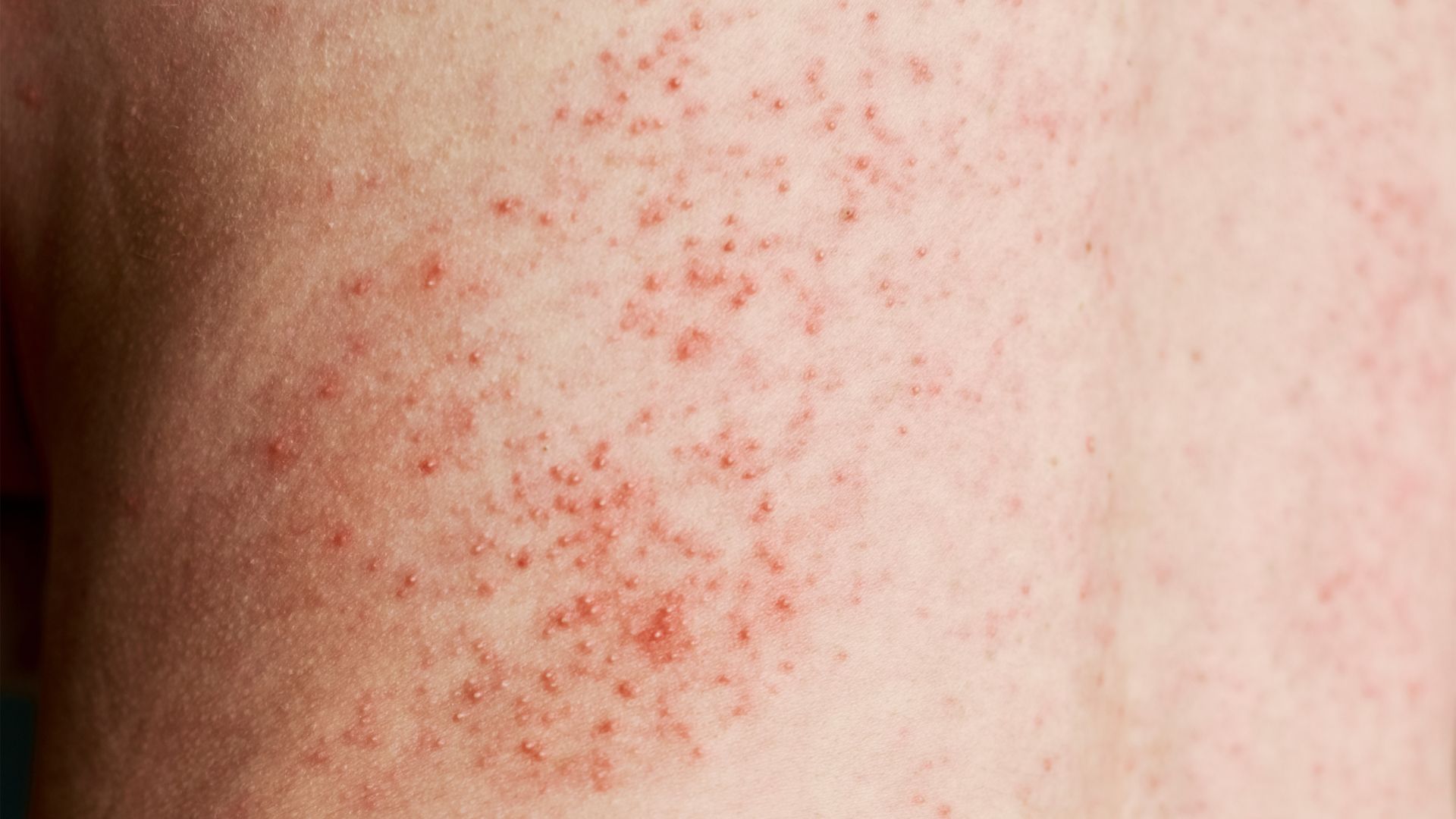Erupções na pele causada pela Febre Maculosa