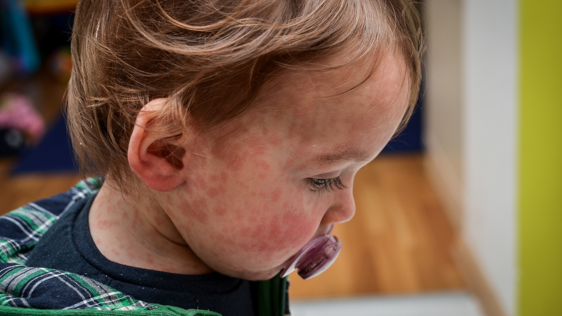 Criança com o rosto vermelho de alergia