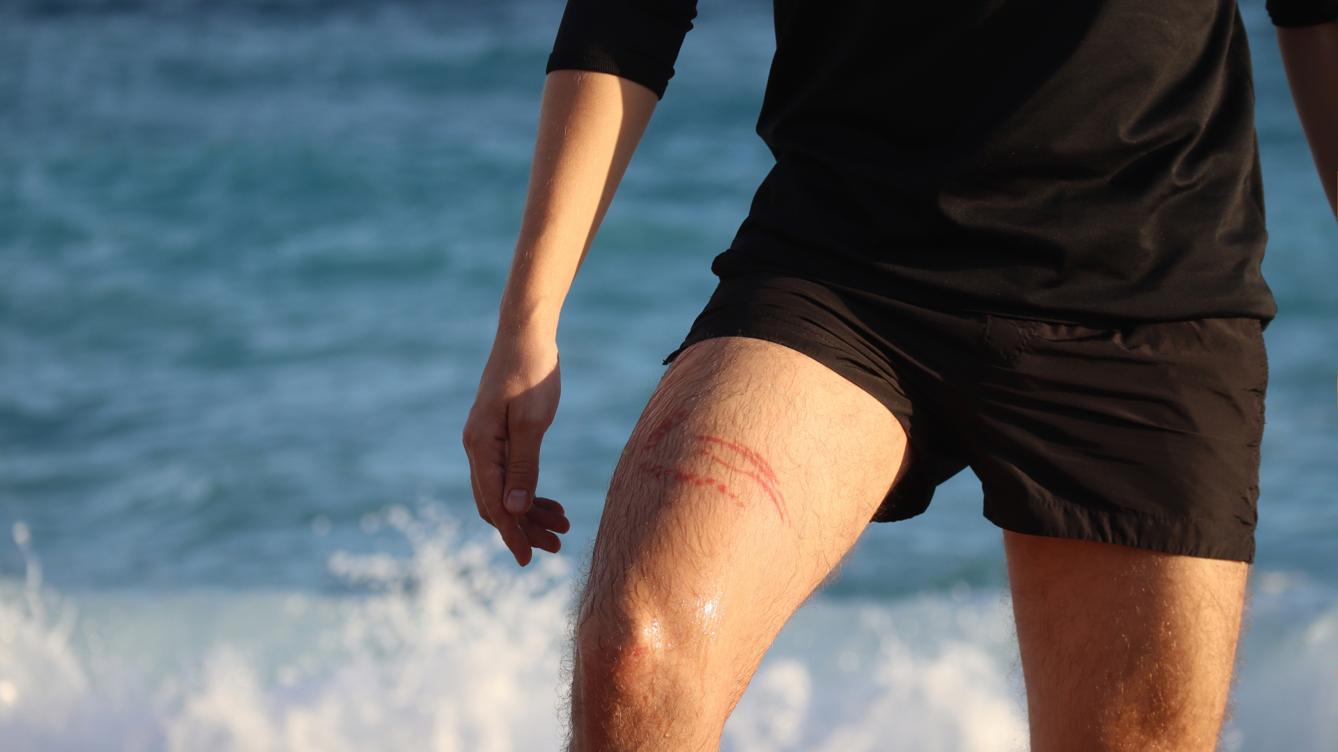 Marca de queimadura por água-viva na perna